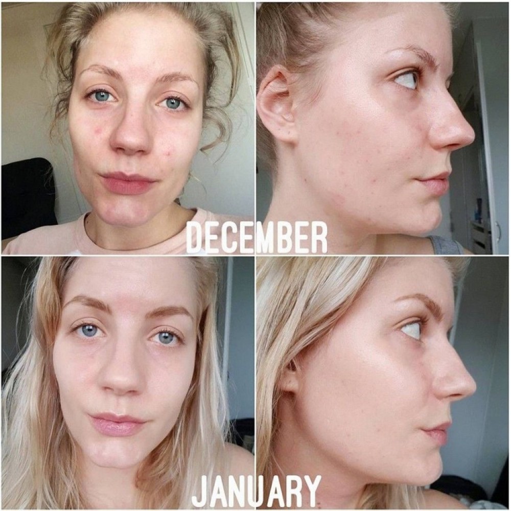 The Ordinary Niacinamide 10% + Zinc 1% 30ML Face Serum